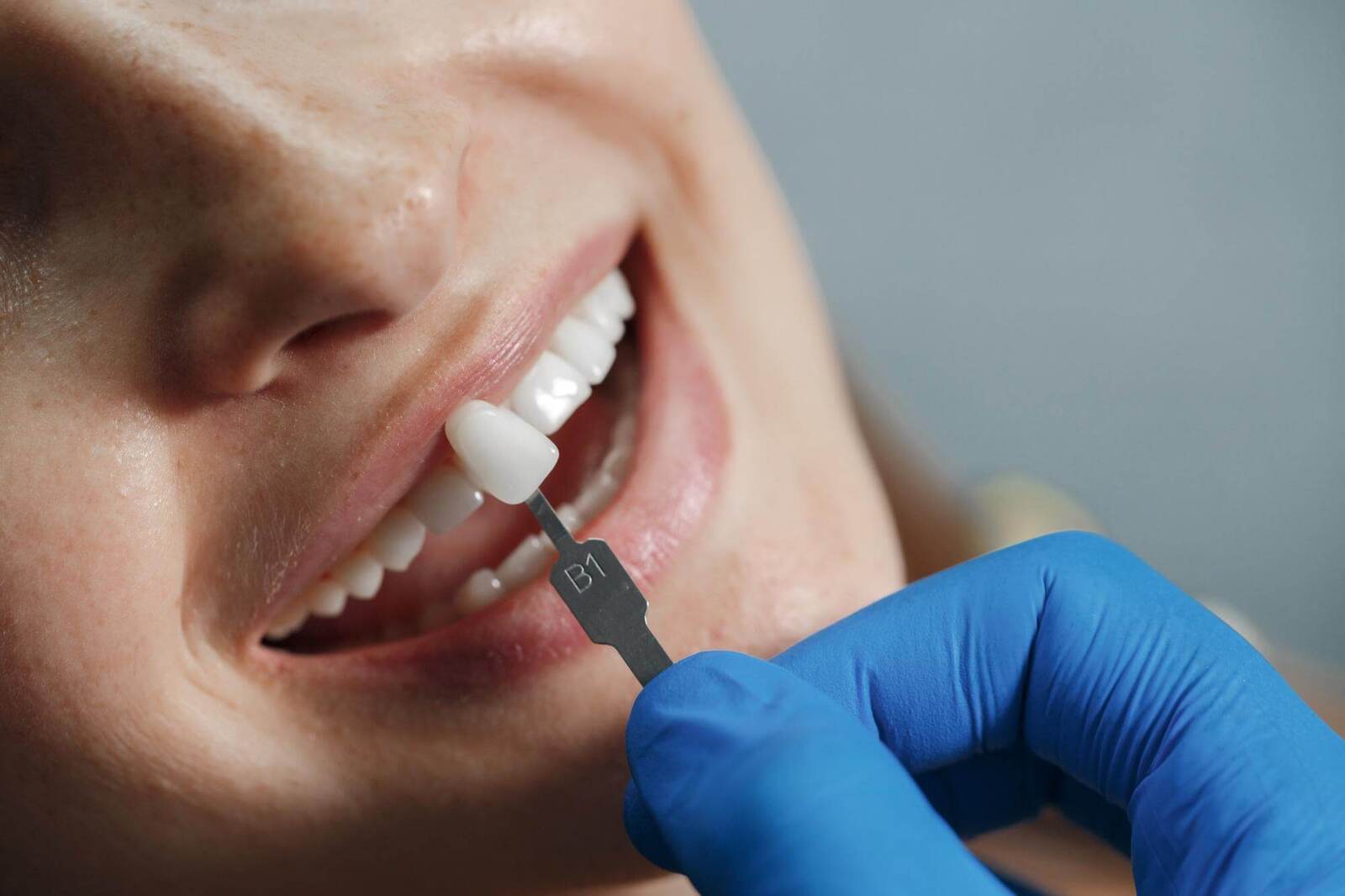 Carillas de porcelana vs composite: ¿cuál elegir?