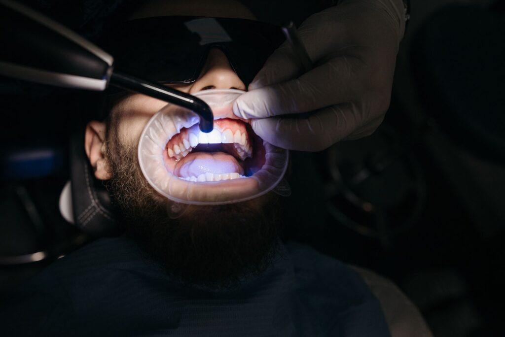 ¿Cómo saber si una caries llegado al nervio?